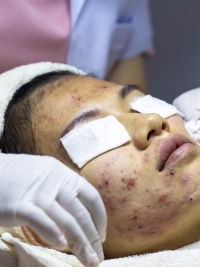 ACNE TREATMENT