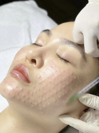 Meso phục hồi, căng bóng