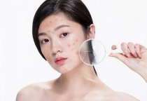 Các bước chăm sóc da chắc chắn giúp sạch mụn chỉ sau 1 tuần