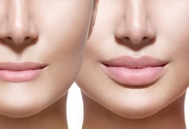 Sử dụng phương pháp trẻ hóa da mặt Botox hay Filler sẽ giúp các chị em phụ nữ có thể “trở lại tuổi thanh xuân” an toàn và hiệu quả?