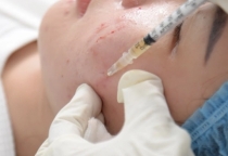 PRP - Phục hồi