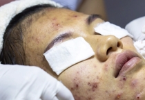 ACNE TREATMENT