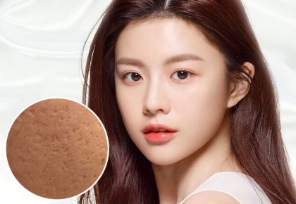 Nguyên nhân bị sẹo rỗ và cách khắc phục sẹo rỗ hiệu quả từ chuyên gia