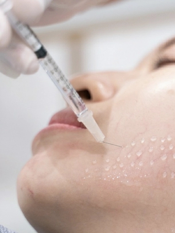 Meso cấp ẩm, mềm da